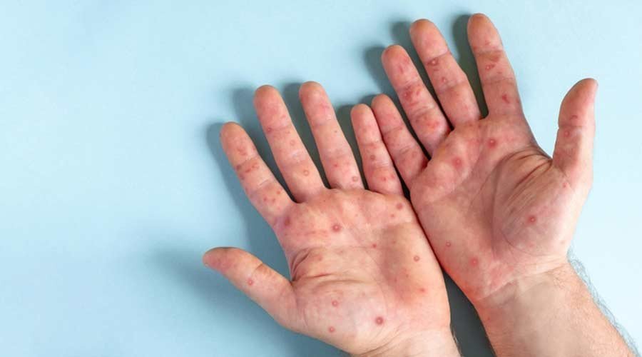 Dugaan Kasus Monkeypox, Dinkes Riau Lakukan Pelacakan Intensif